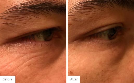 7 - Before and After Real Results photo of a man's eye area.